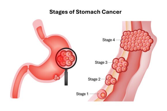 Stages of Stomach Cancer Progression